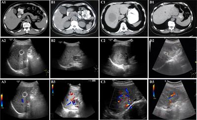 Specific imaging features indicate the clinical features of patients with hepatic perivascular epithelioid cell tumor by comparative analysis of CT and ultrasound imaging